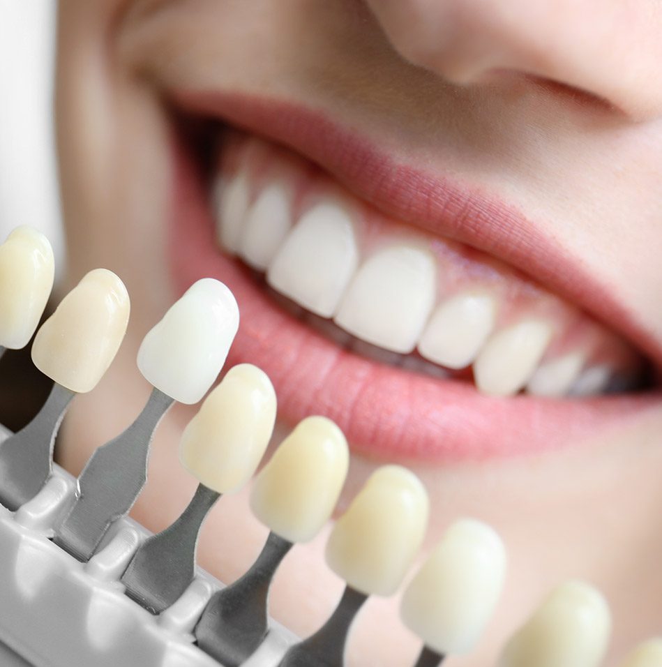 Benefits of porcelain veneers | East Abbotsford Dental | General Dentist | Abbotsford, BC