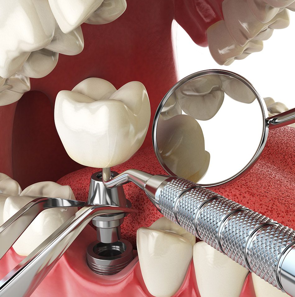 Dental Implant Surgery | East Abbotsford Dental | Family and General Dentist | Abbotsford, BC