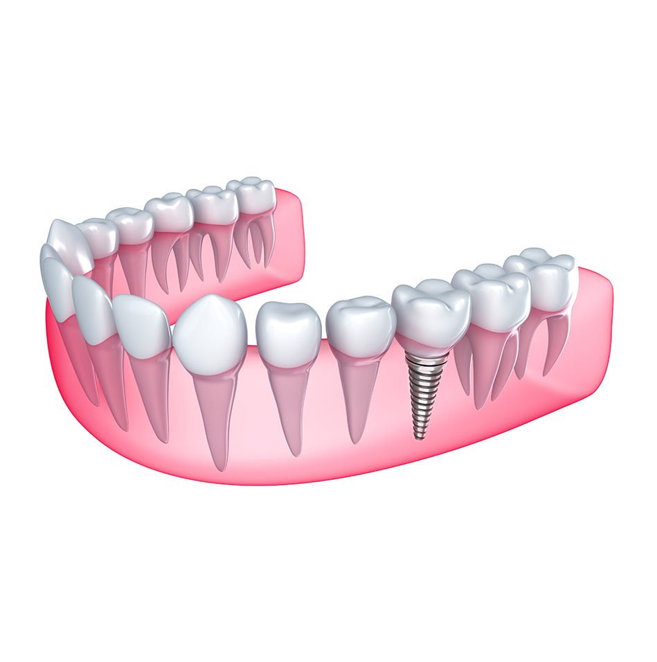 Dental Implants | East Abbotsford Dental | Family and General Dentist | Abbotsford, BC