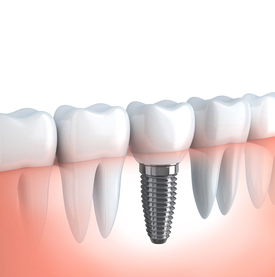 Dental Implants Service | East Abbotsford Dental | Abbotsford, BC