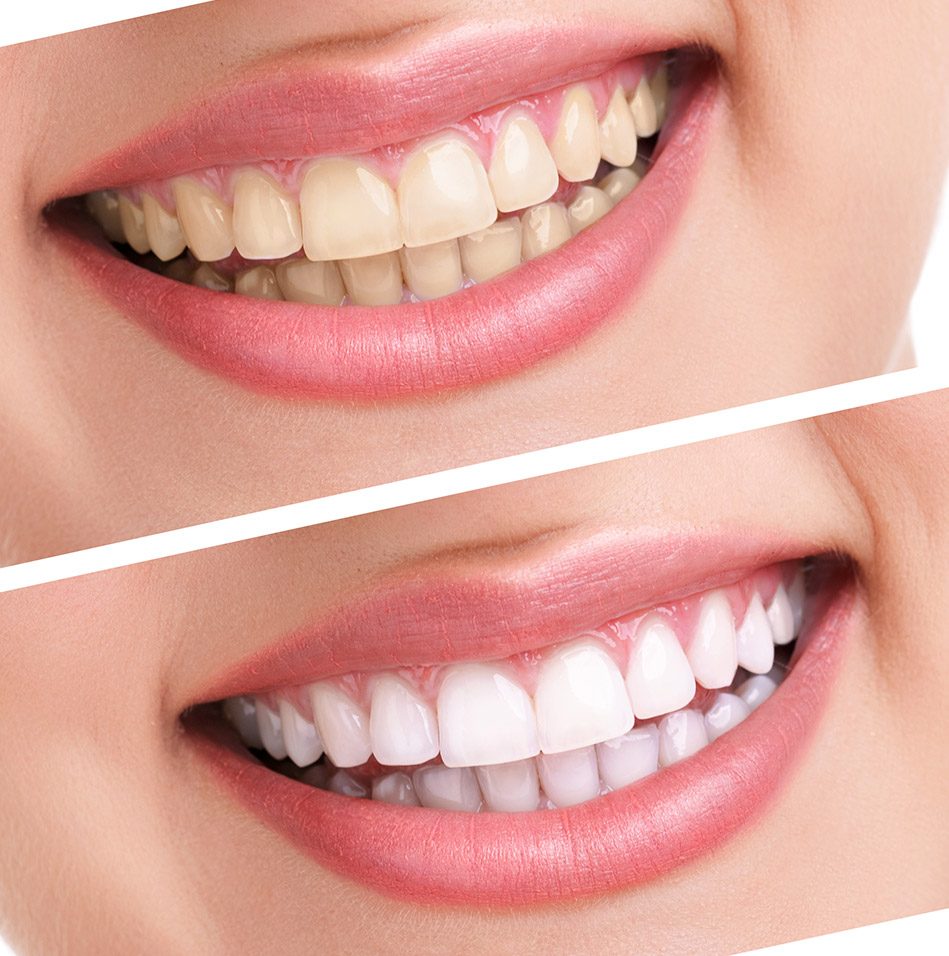 Teeth Whitening Treatment | East Abbotsford Dental | General Dentist in Abbotsford, BC