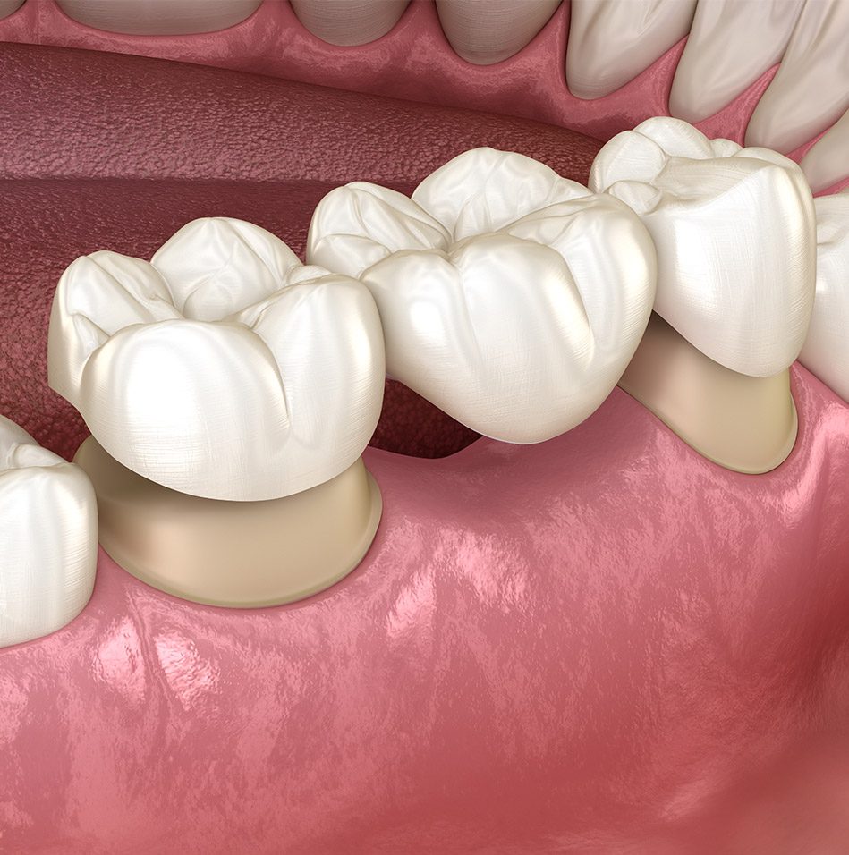 What is a dental bridge | East Abbotsford Dental | Abbotsford, BC