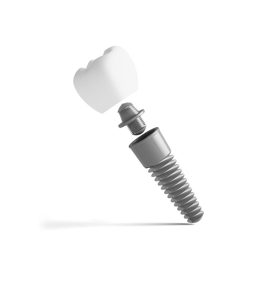 What s a dental implant | East Abbotsford Dental | Family and General Dentist | Abbotsford, BC