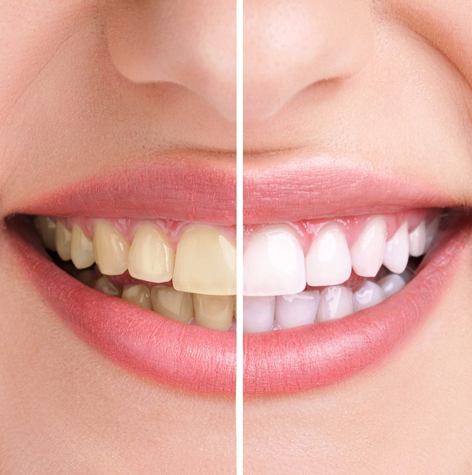 What is teeth whitening | East Abbotsford Dental | General Dentist | Abbotsford, BC