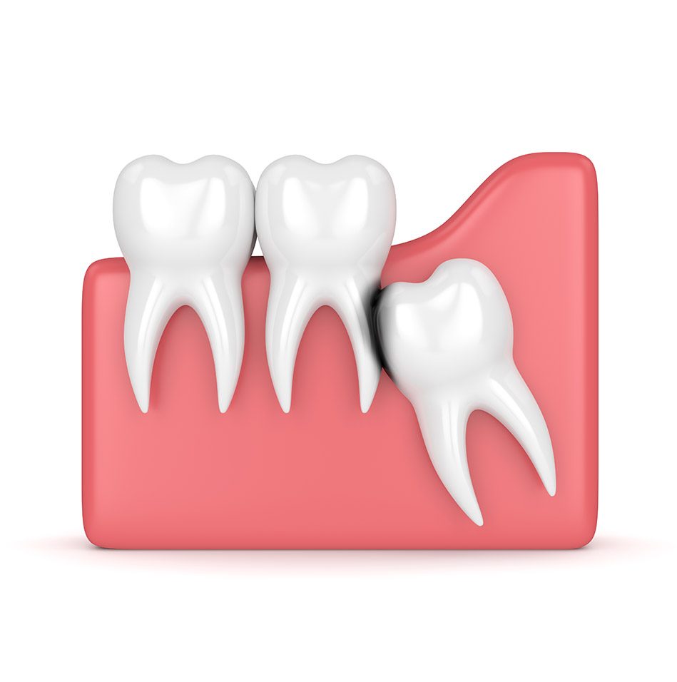 Wisdom Teeth Extractions | East Abbotsford Dental | Abbotsford, BC